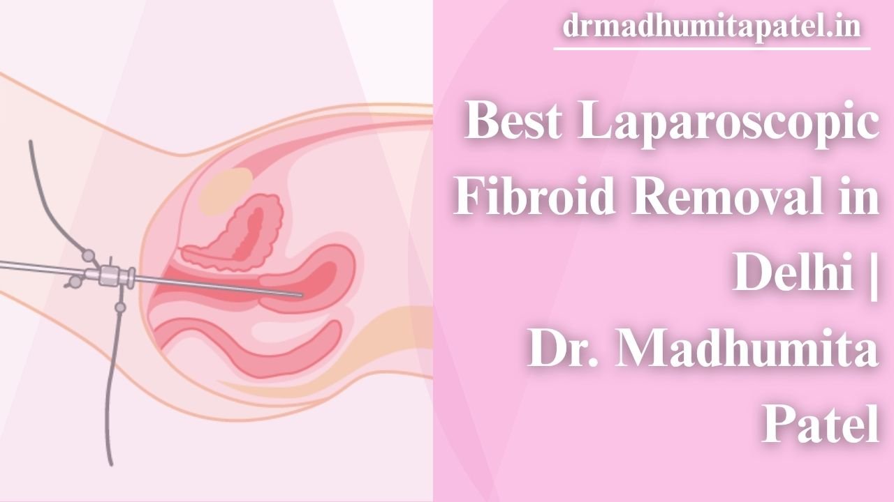 Best Laparoscopic Surgery for Fibroids: What You Need to Know