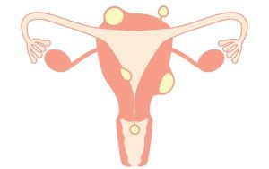 best laparoscopic fibroid removal in Delhi
