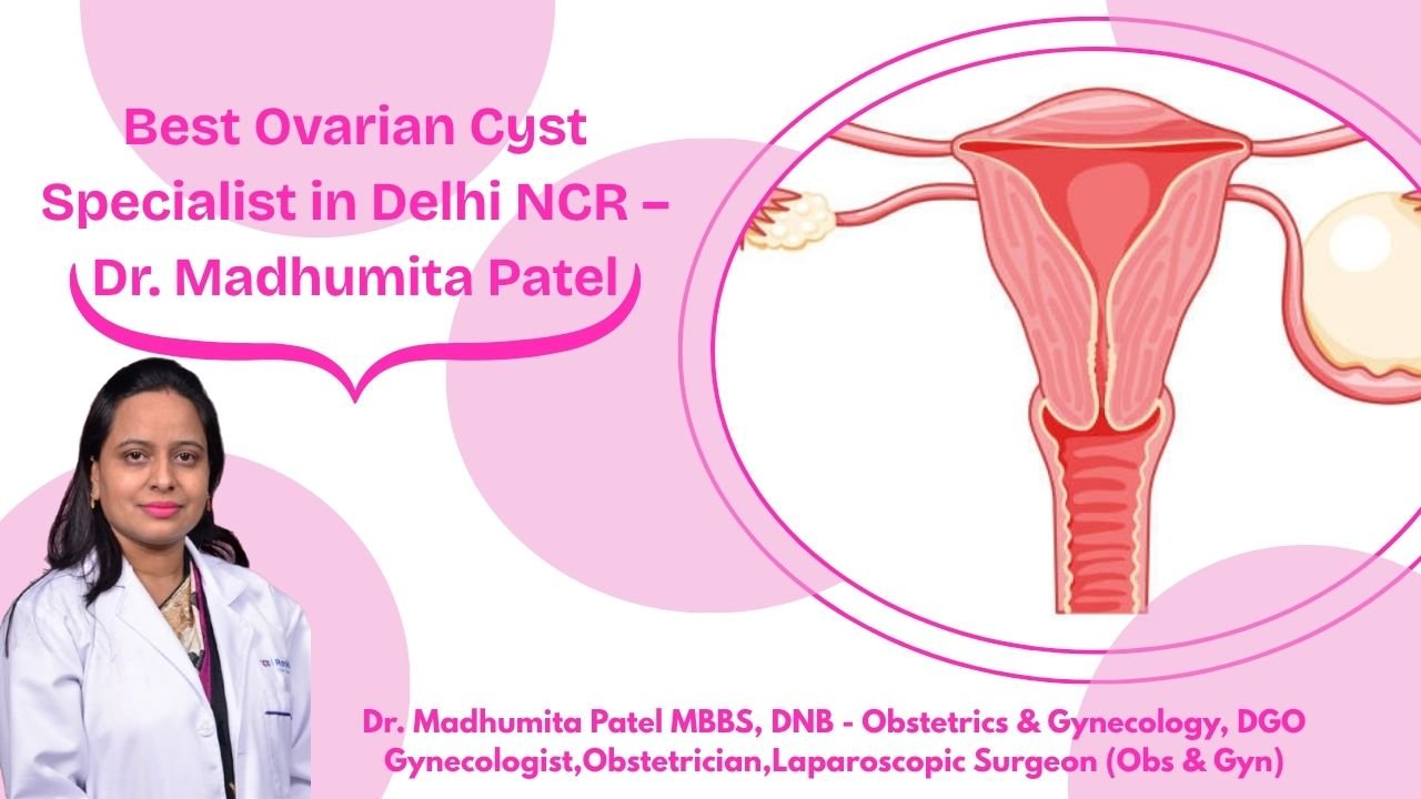 Best ovarian cyst specialist in Delhi NCR