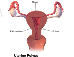 Uterine Polyps